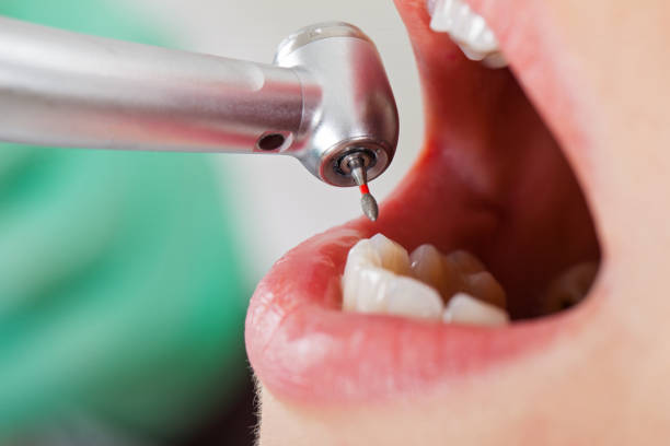 Best Emergency Root Canal Treatment in Mcminnville, TN